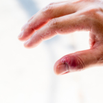 Nagelbandsinfektion (paronyki): orsak, symtom & egenvård